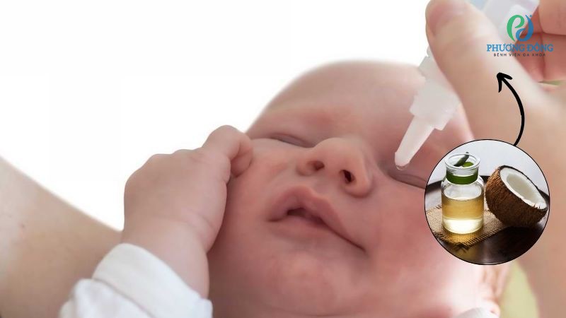 Bác sĩ Nhãn khoa giải đáp: Dầu dừa vào mắt trẻ sơ sinh có sao không?