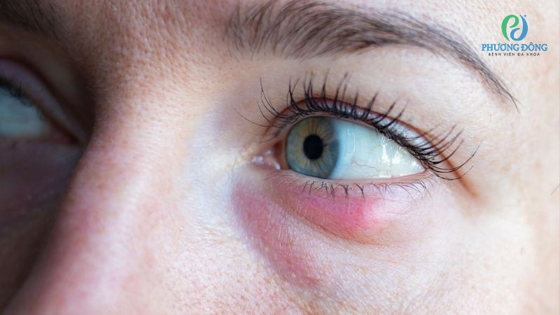 Giải đáp với bác sĩ Nhãn khoa: Đau mắt đỏ có nguy hiểm không?