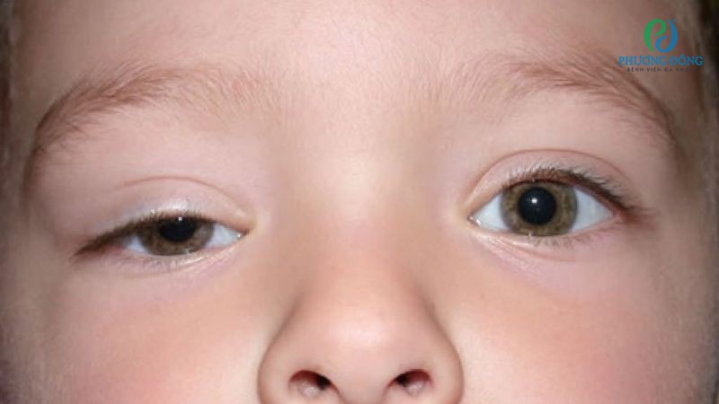 Những trường hợp cảnh báo trẻ sơ sinh mắt to mắt nhỏ phải can thiệp y tế