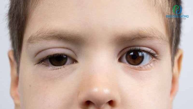 Giải đáp cùng bác sĩ: Trẻ sơ sinh mắt to mắt nhỏ có sao không?