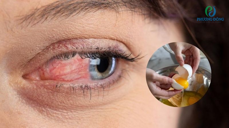 Hỏi - Đáp với bác sĩ: Đau mắt đỏ có ăn được trứng gà không?