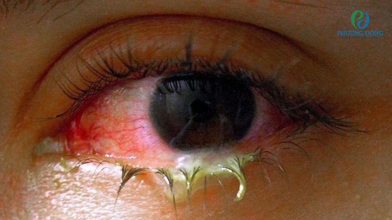 Đau mắt đỏ có thể tự khỏi sau 7 - 10 ngày chăm sóc tại nhà