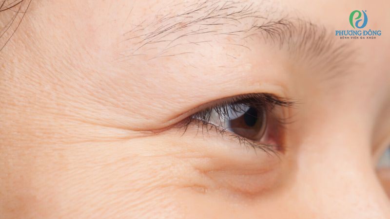 Hạn chế nheo mắt, ngủ ít, dùng thiết bị điện tử để cải thiện tình trạng nếp nhăn ở mắt