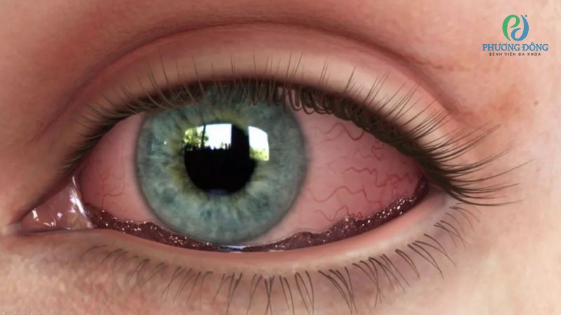 Tùy theo mức độ tổn thương và phạm vi vết rách giác mạc mà thị lực có thể bị ảnh hưởng