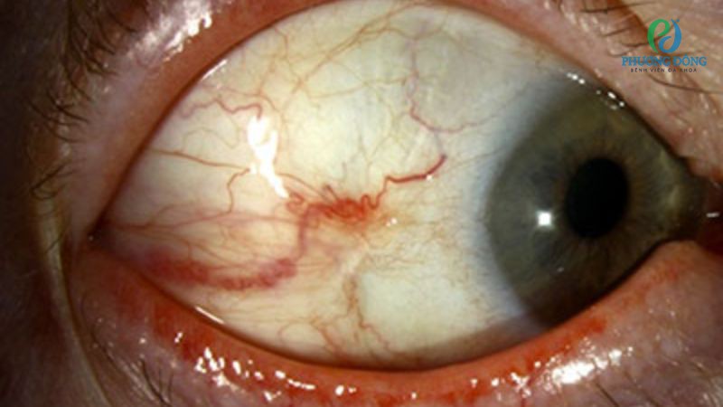 Giải đáp cùng bác sĩ: Rách màng mắt có sao không?