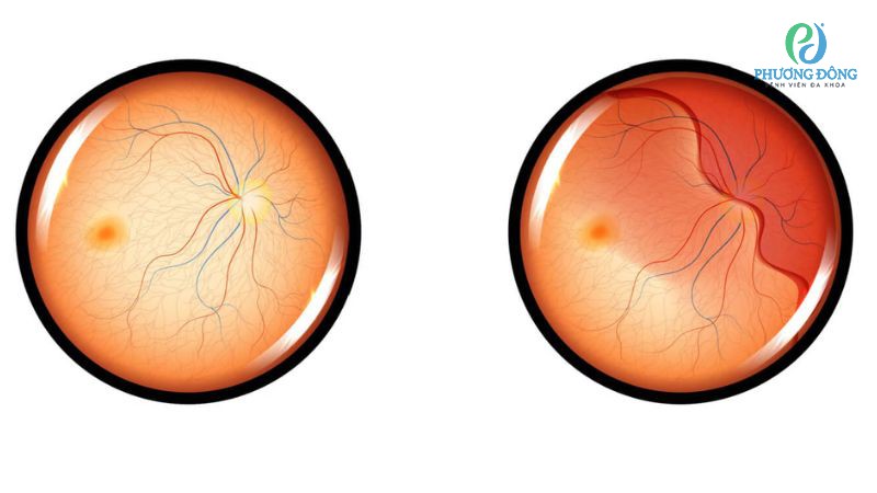 Tách lớp võng mạc là một dạng tổn thương mắt nguy hiểm