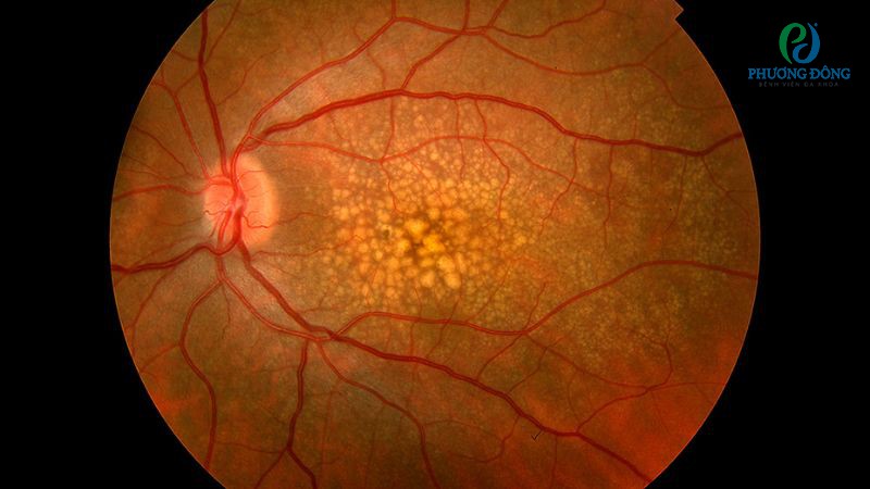 Thoái hóa võng mạc có thể chữa trị nhưng không thể khôi phục hoàn toàn thị lực đã mất