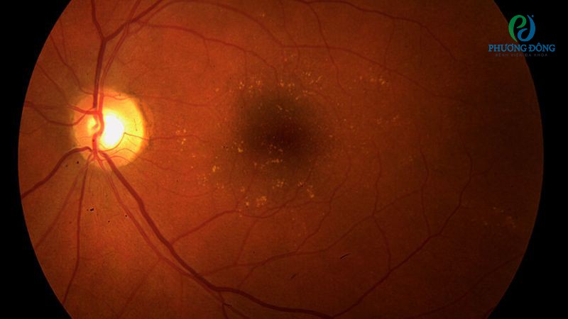 Hỏi - Đáp với bác sĩ: Thoái hoá võng mạc có chữa được không?