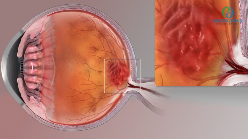 Biến chứng nguy hiểm nếu thoái hóa võng mạc không được điều trị kịp thời