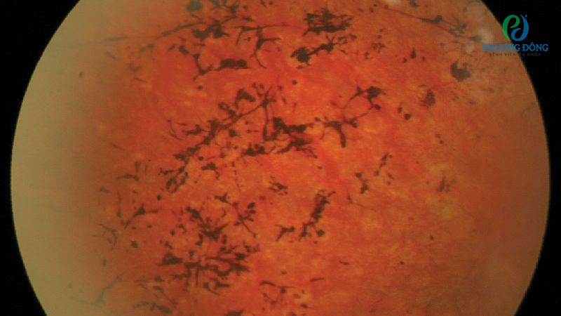 Viêm võng mạc không điều trị sớm có thể gây phù võng mạc, xuất huyết, hoại tử mô hoặc để lại sẹo