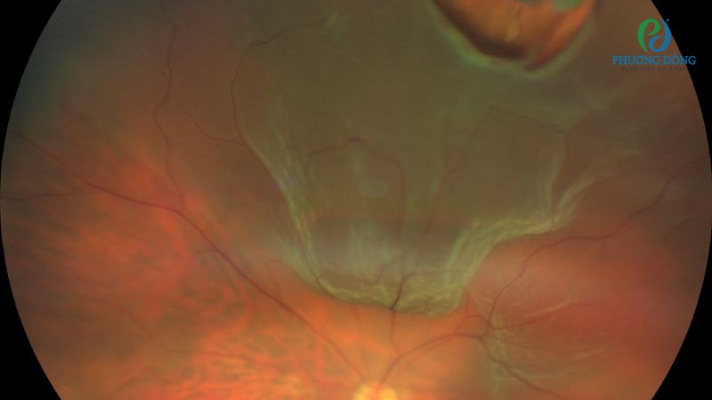 Giải đáp cùng bác sĩ: Viêm võng mạc có nguy hiểm không?