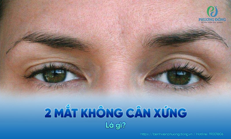 2 mắt không cân xứng là như thế nào? Cách khắc phục an toàn và hiệu quả