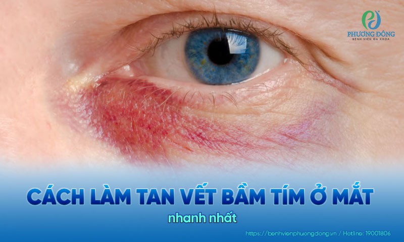 Cách làm tan vết bầm tím ở mắt nhanh nhất và hiệu quả cao