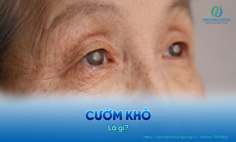 Cườm khô: Nguyên nhân, triệu chứng và hướng điều trị