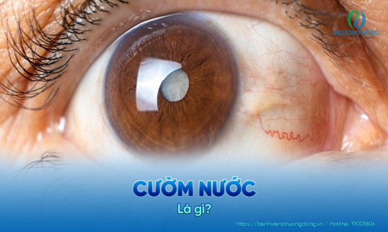 Cườm nước: Nguyên nhân, triệu chứng và hướng điều trị