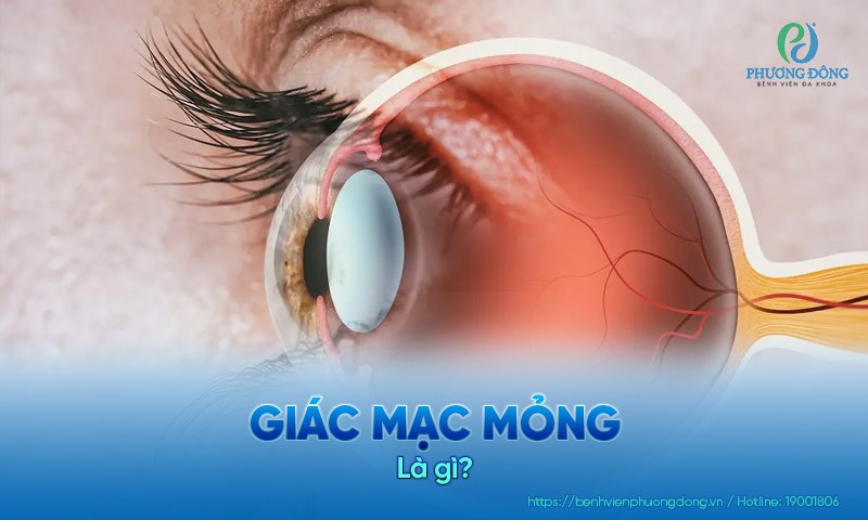 Giác mạc mỏng: Nguyên nhân, biến chứng và hướng chẩn đoán