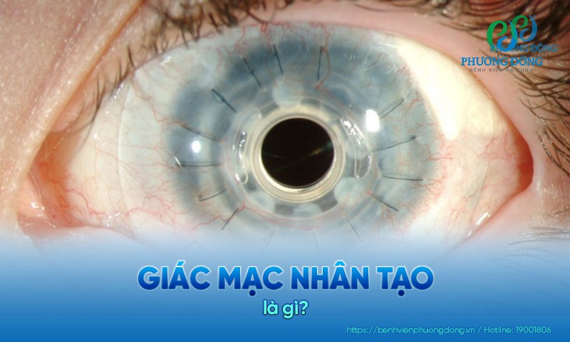 Giác mạc nhân tạo: Chỉ định, phương pháp và kỹ thuật thực hiện