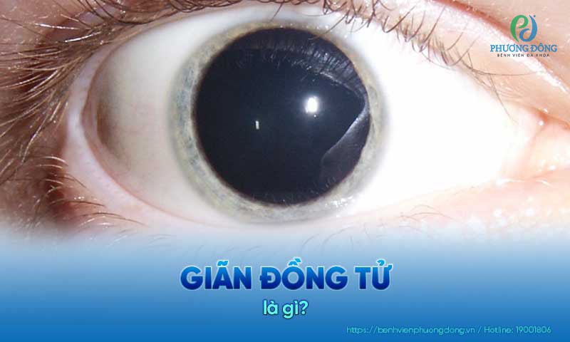 Giãn đồng tử: Triệu chứng, nguyên nhân và hướng điều trị