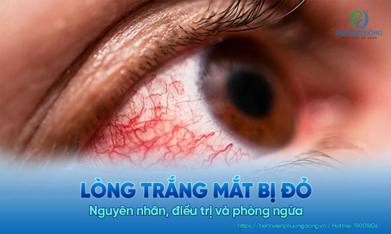Lòng trắng mắt bị đỏ: Nguyên nhân, điều trị và phòng ngừa