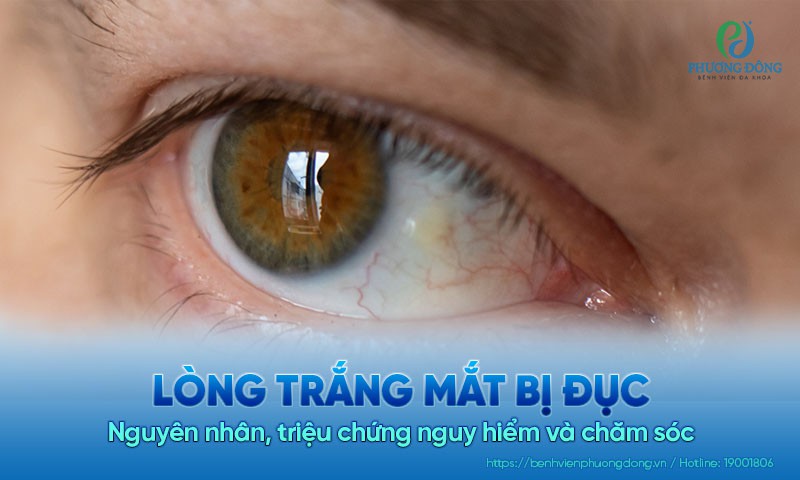 Lòng trắng mắt bị đục: Nguyên nhân, triệu chứng nguy hiểm và chăm sóc
