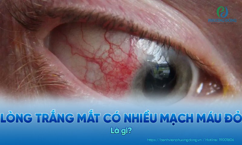 Lòng trắng mắt có nhiều mạch máu đỏ do đâu? Điều trị và phòng ngừa
