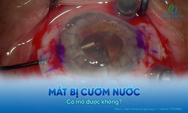 Mắt bị cườm nước có mổ được không? Khi nào nên và không nên mổ