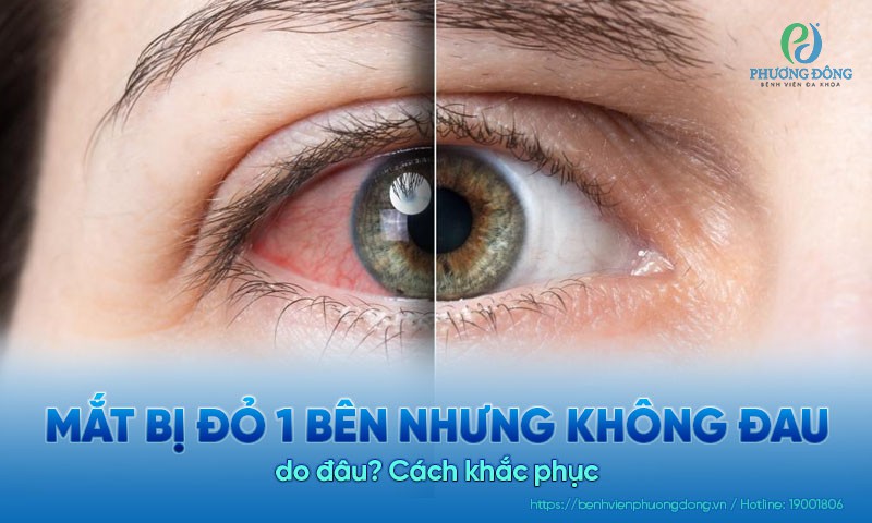 Mắt bị đỏ 1 bên nhưng không đau do đâu? Cách khắc phục