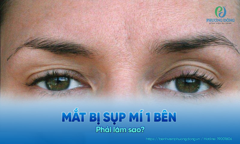 Mắt bị sụp mí 1 bên phải làm sao? Nguyên nhân khiến mắt sụp mí 1 bên