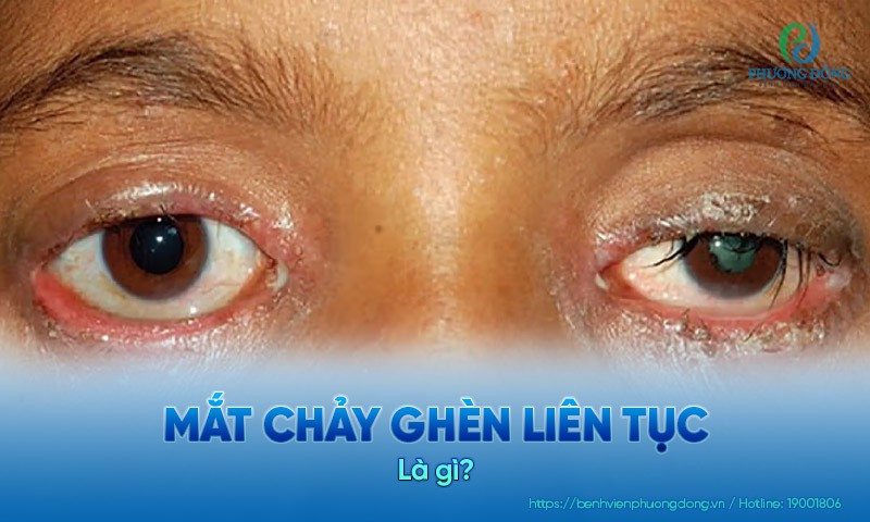 Mắt chảy ghèn liên tục: Nguyên nhân, cách xử trí và phòng tránh