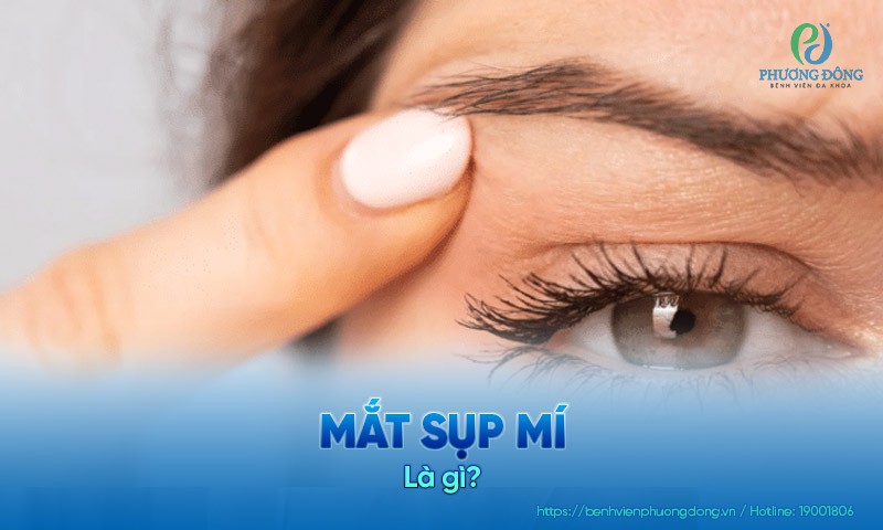 Mắt sụp mí: Nguyên nhân, dấu hiệu và hướng điều trị