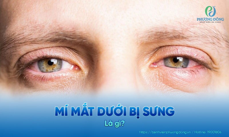 Mí mắt dưới bị sưng: Nguyên nhân, triệu chứng và hướng điều trị