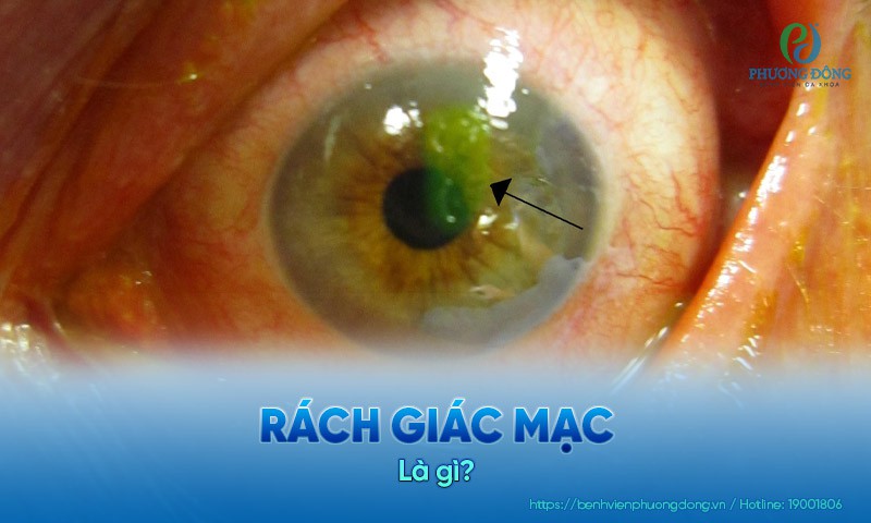 Rách giác mạc: Nguyên nhân, triệu chứng và hướng điều trị