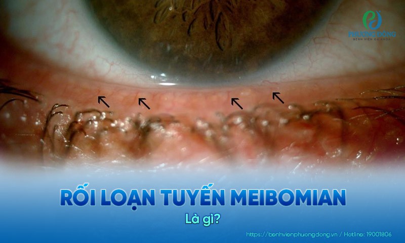 Rối loạn tuyến Meibomian: Yếu nguy cơ và cách cải thiện