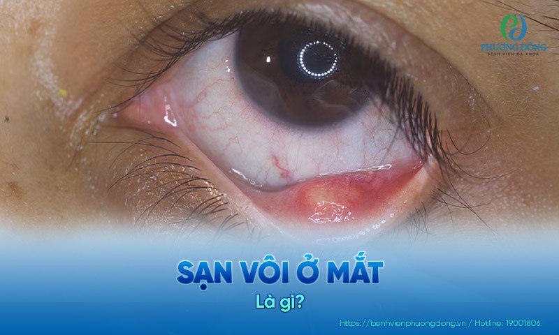 Sạn vôi là hệ quả của quá trình lắng đọng calci bên dưới lớp kết mạc sụn mi nhãn cầu