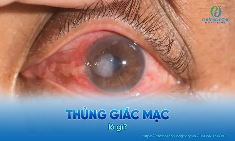 Thủng giác mạc: Nguyên nhân, triệu chứng và hướng điều trị