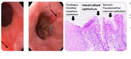 Barrett thực quản- theo dõi và điều trị đúng để phòng ung thư