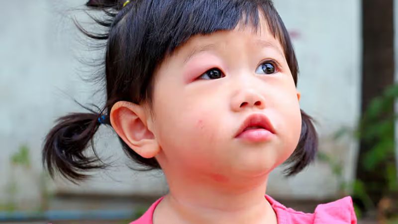 Viêm mô tế bào cũng có thể là nguyên nhân khiến bé bị đau mắt