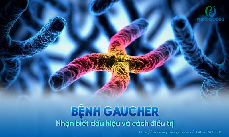 Bệnh Gaucher: Nhận biết dấu hiệu và cách điều trị