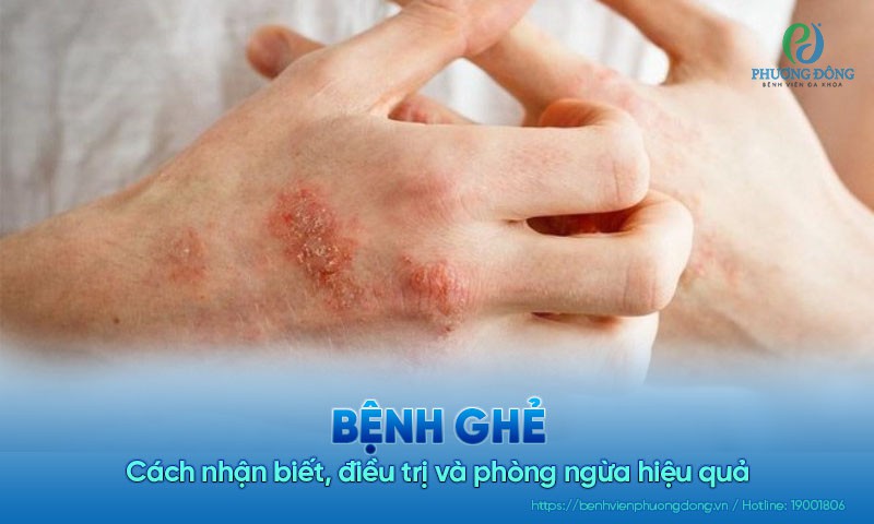 Bệnh ghẻ: Cách nhận biết, điều trị và phòng ngừa hiệu quả