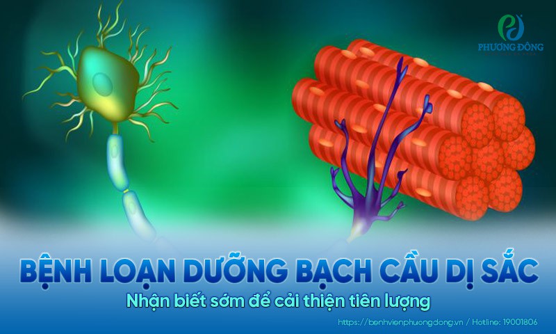 Bệnh loạn dưỡng bạch cầu dị sắc: Nhận biết sớm để cải thiện tiên lượng