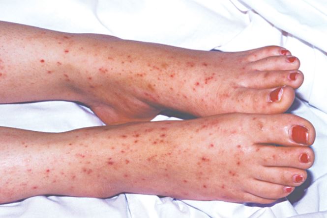 Bệnh não mô cầu và vaccine mới