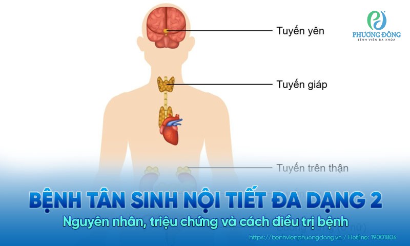 Bệnh tân sinh nội tiết đa dạng 2: Nguyên nhân, triệu chứng và cách điều trị