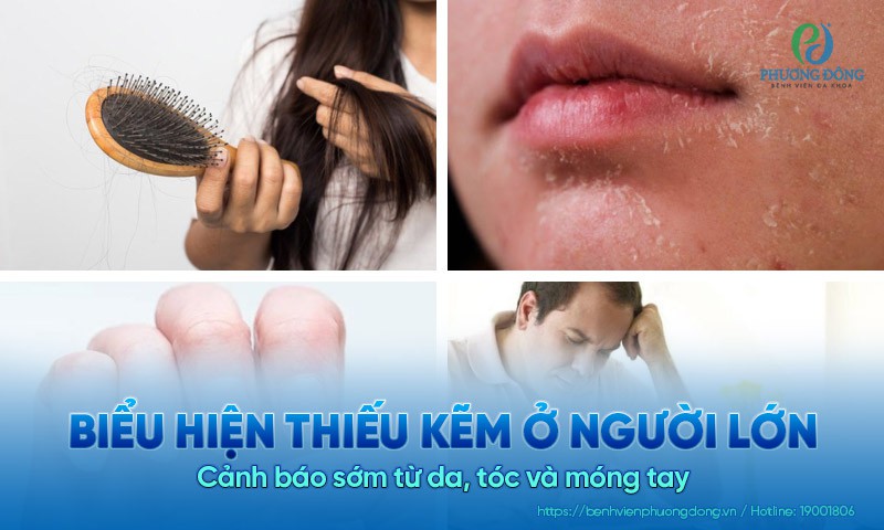 Biểu hiện thiếu kẽm ở người lớn: Cảnh báo sớm từ da, tóc và móng tay