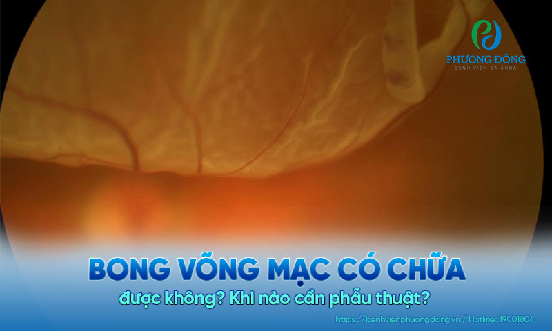 Bong võng mạc có chữa được không? Khi nào cần phẫu thuật? 