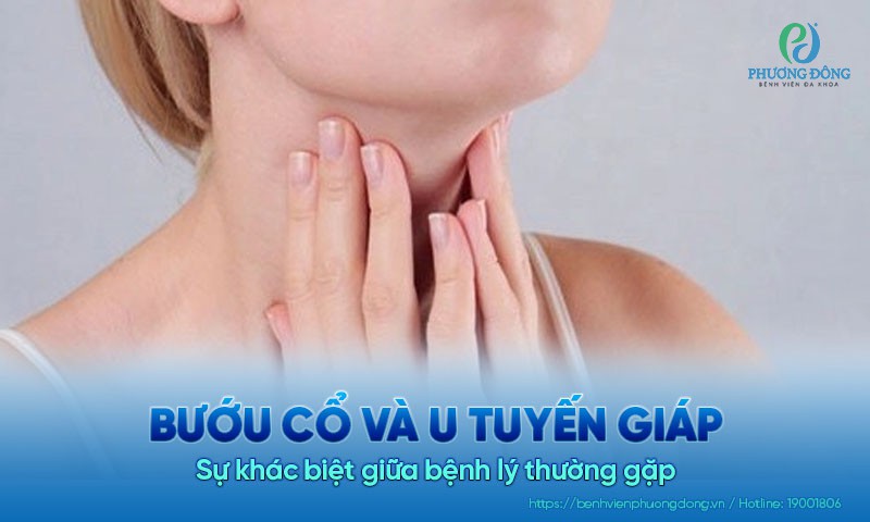 Sự khác biệt giữa bệnh bướu cổ và u tuyến giáp