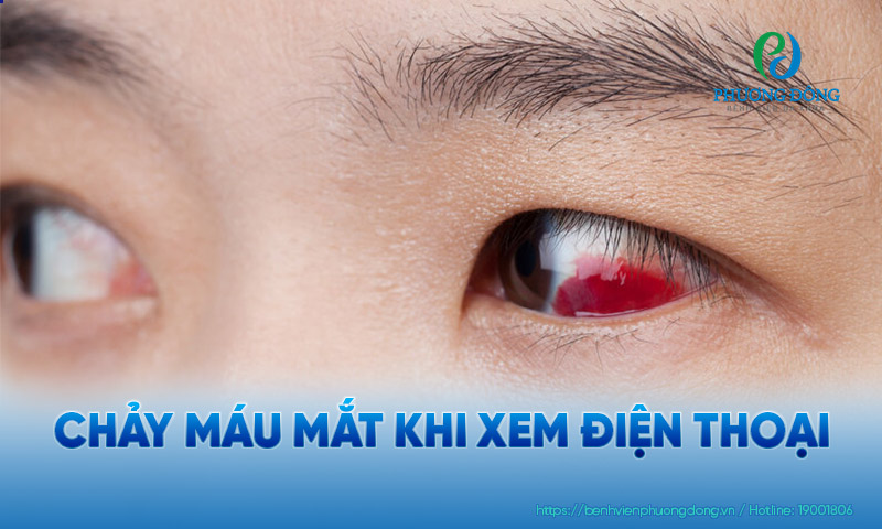 Hiện tượng xuất huyết dưới kết mạc khá thường gặp