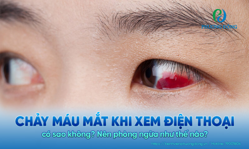 Chảy máu mắt khi xem điện thoại có sao không? Nên phòng ngừa như thế nào?  