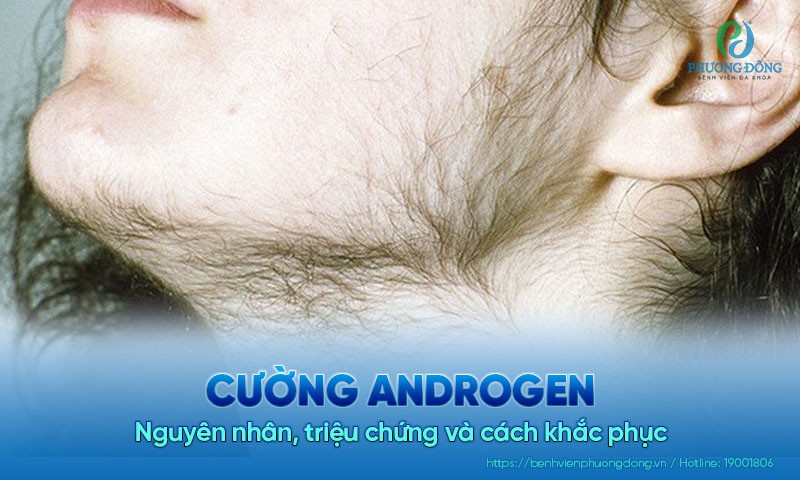 Cường androgen ở nữ giới: Nguyên nhân, triệu chứng và cách khắc phục