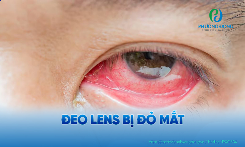 Bị đỏ mắt sau khi đeo lens có thể xuất hiện khi bạn tháo kính sau vài giờ