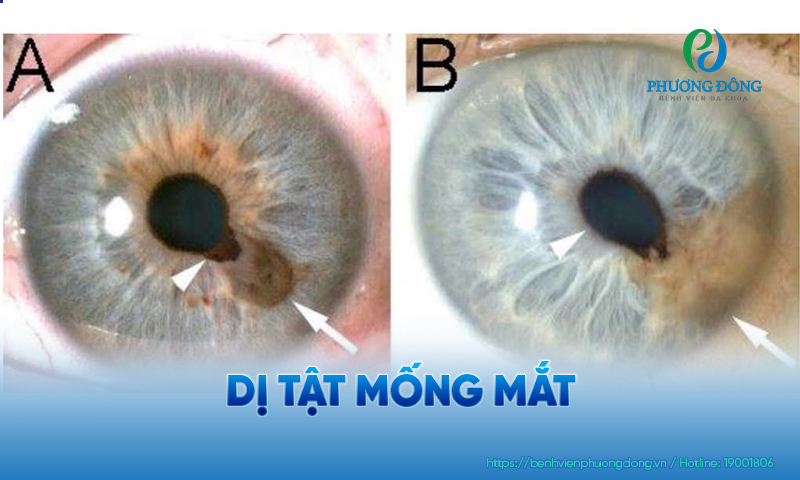 Bất thường ở mống mắt có thể được phát hiện ngay khi còn nhỏ